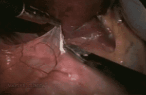 Exérese laparoscópica de paraganglioma retrocava