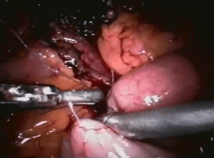 Cistectomia radical laparoscópica com neobexiga - Master Clínica