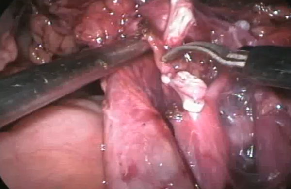 Reimplantação ureteral minimamente invasivo em endometriose severa - Master Clínica