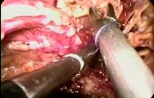 Fístula enteral - Master Clínica