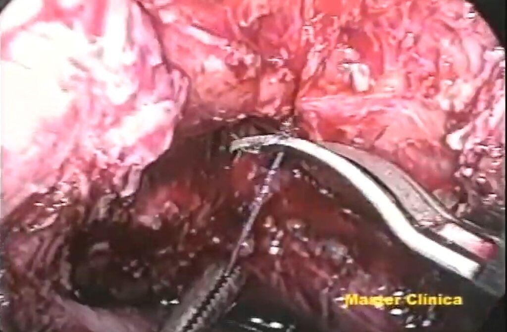Correção laparoscópica de fístula vesicovaginal - Master Clínica