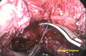 Correção laparoscópica de fístula vesicovaginal - Master Clínica