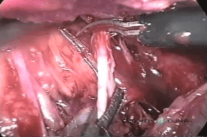 Abordagem laparoscópica para ureterólise - Master Clínica