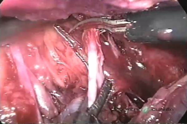 Abordagem laparoscópica para ureterólise - Master Clínica