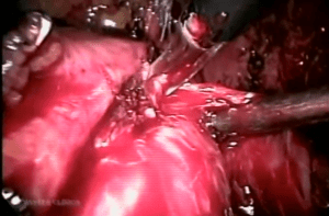 Prostatectomia radical videolaparoscópica