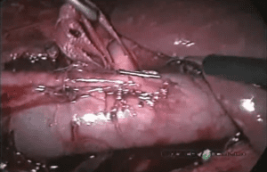 Reparo laparoscópico de ureter retrocava - Master Clínica