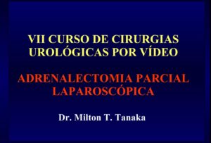 Adrenalectomia parcial videolaparoscópica - Aula Master Clínica