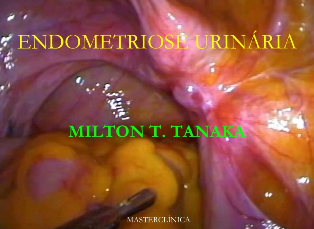 Endometriose urinária - correção laparoscópica - Aula Master Clínica