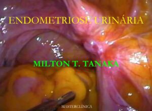 Endometriose urinária - correção laparoscópica - Aula Master Clínica