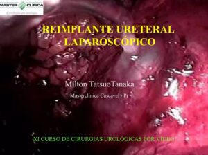 Reimplante ureteral laparoscópico - Aula Master Clínica