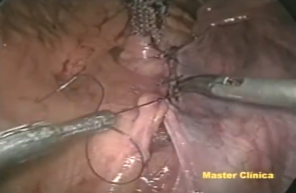 Reparo laparoscópico de prolapso de cúpula vaginal - Master Clínica