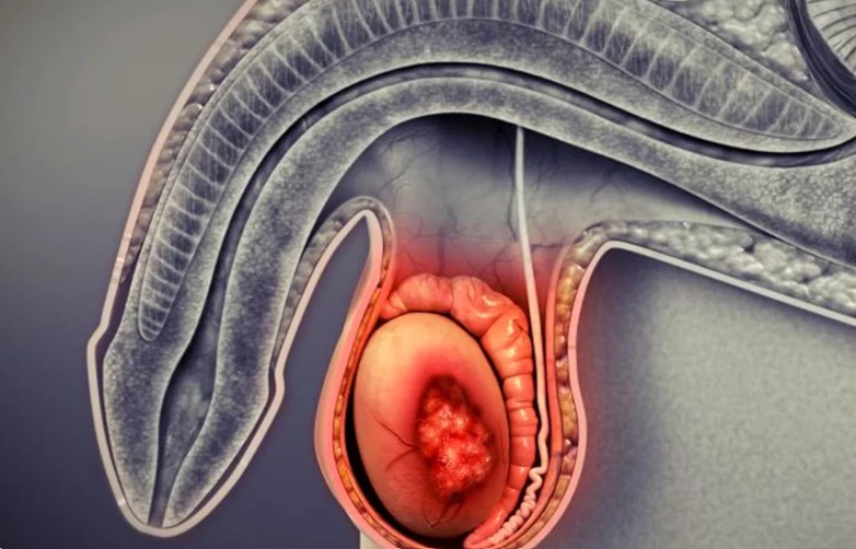 Orquiectomia (inguinal) - Câncer de testículo
