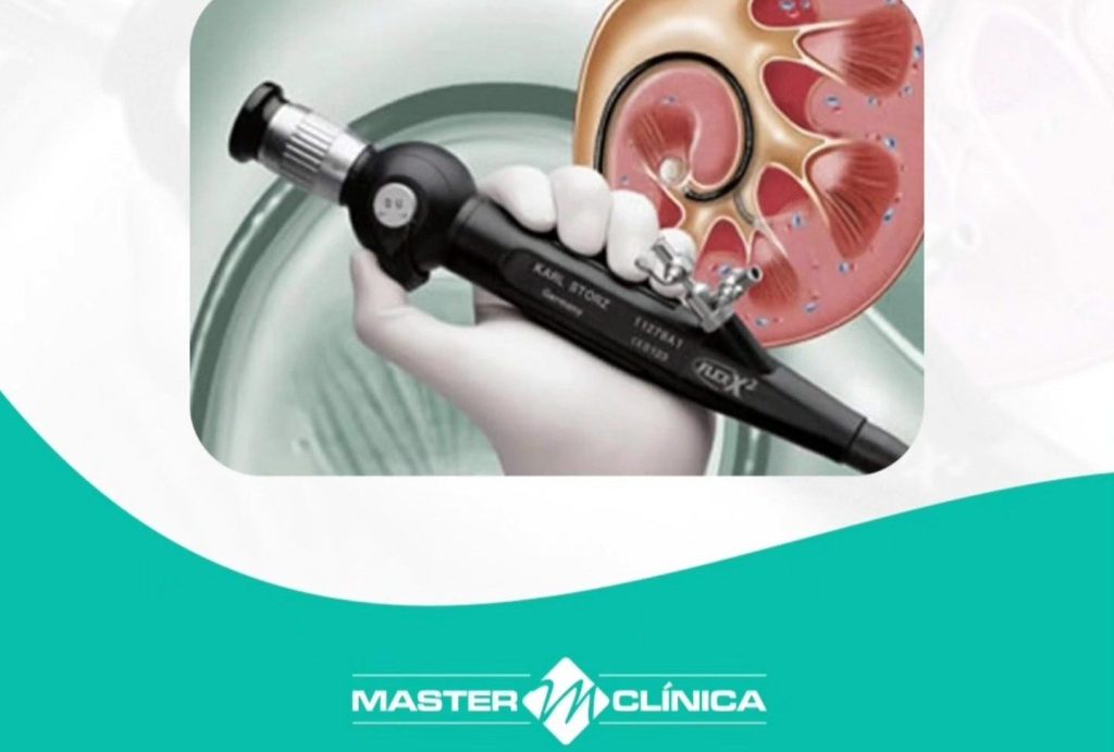 Especialistas em cálculo renal