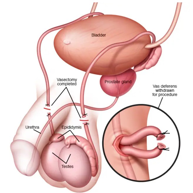 Imagem ilustrativa sobre o procedimento de vasectomia.