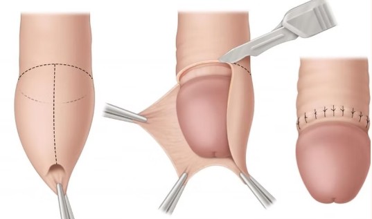 Postectomia - Fimose