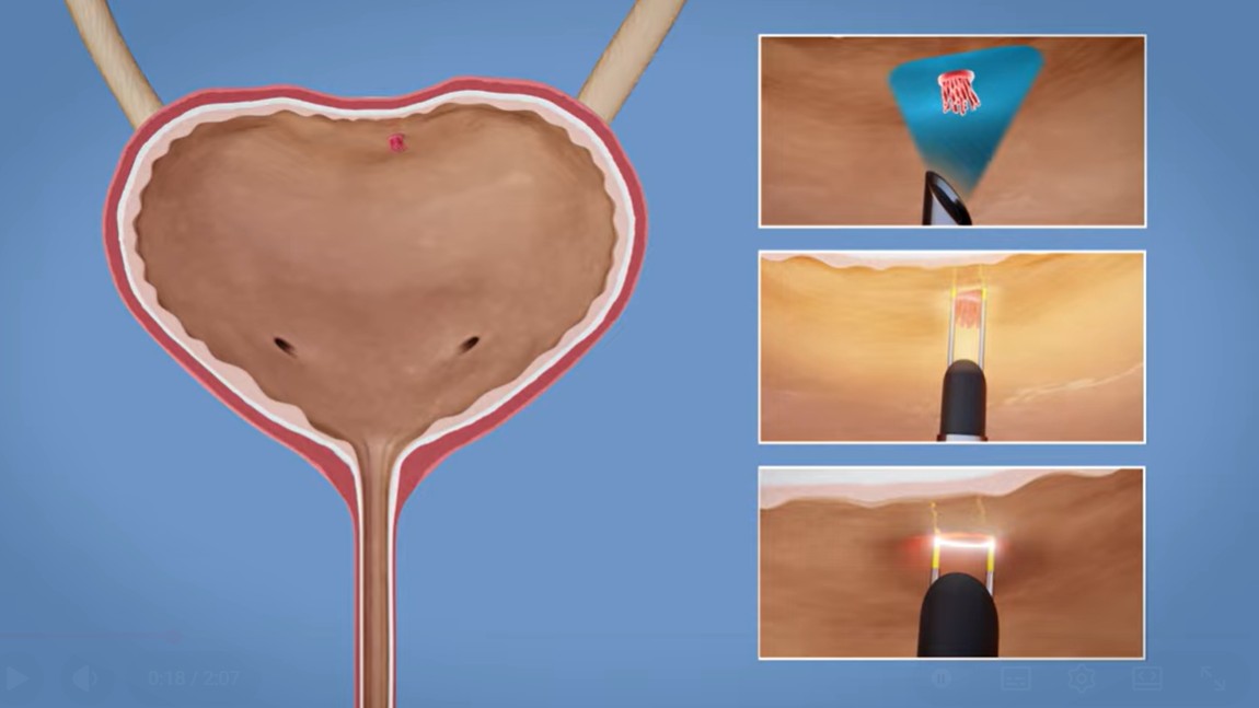 Imagem ilustrativa da ressecção transuretral de bexiga.