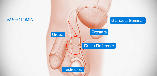Imagem ilustrativa sobre o procedimento de vasectomia.