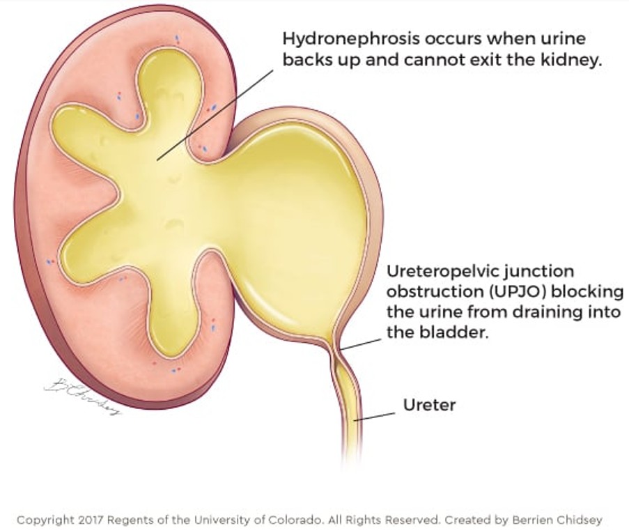 Pieloplastia robótica ou videolaparoscópica - Estenose de JUP