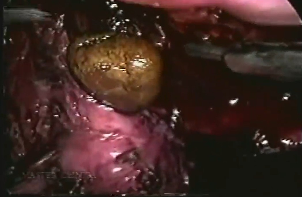 Correção laparoscópica de pseudodivertículos de bexiga