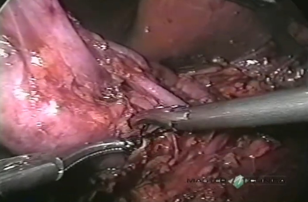 Heminefrectomia polar inferior com ureterectomia laparoscópica