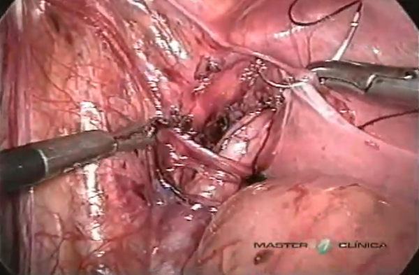 Refluxo vesicoureteral - correção laparoscópica