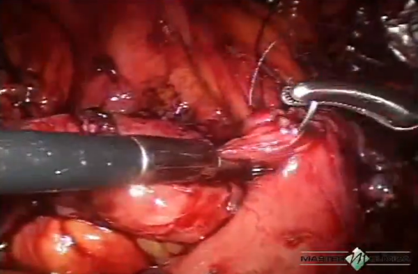 Fístula estercoral para bexiga ampliada - correção laparoscópica