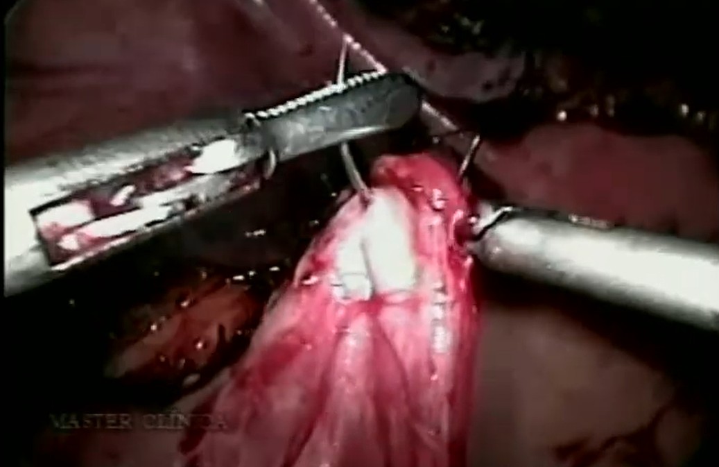 Tuberculose urinária - ileocistoplastia e nefroureterectomia laparoscópica