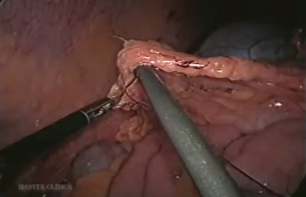 Obstrução do cateter de diálise peritoneal - omentopexia laparoscópica