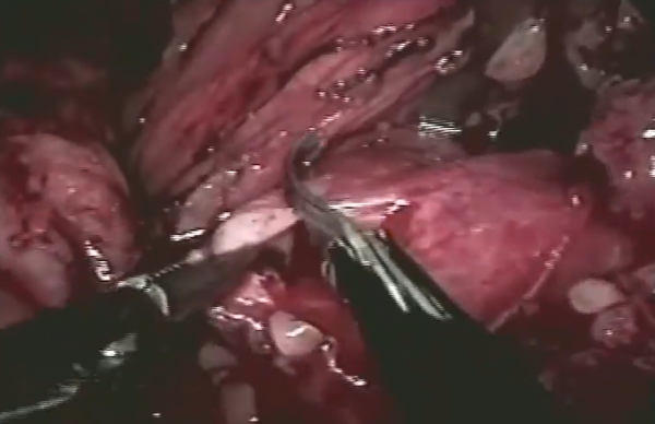 Múltiplos cálculos renais - pielolitotomia laparoscópica e calicoscopia