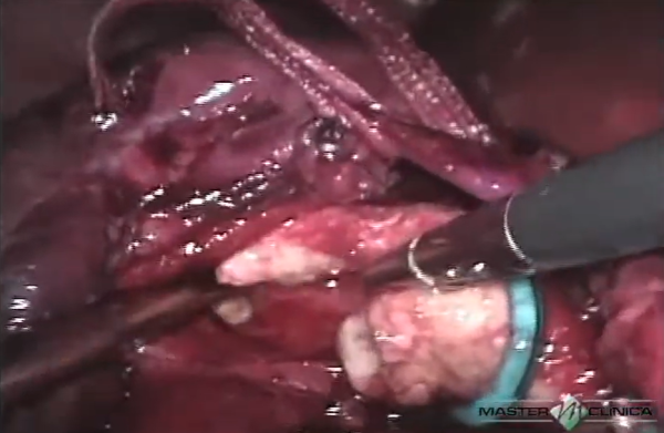 Cálculo coraliforme - Pielolitotomia laparoscópica