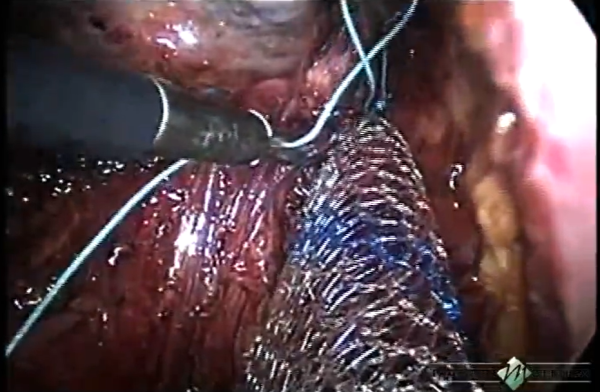 Prolapso de órgãos pélvicos (sacrocolpopexia com duplo retalho por laparoscopia)