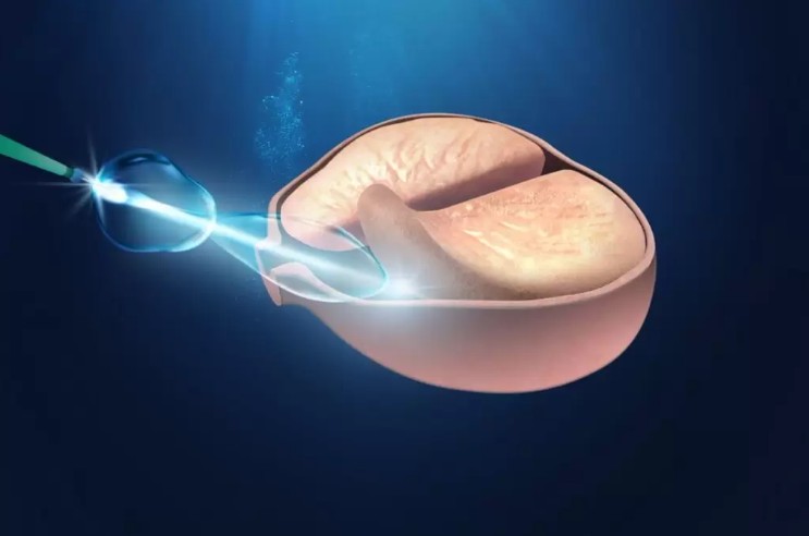 Enucleação endoscópica da próstata com laser - Cascavel